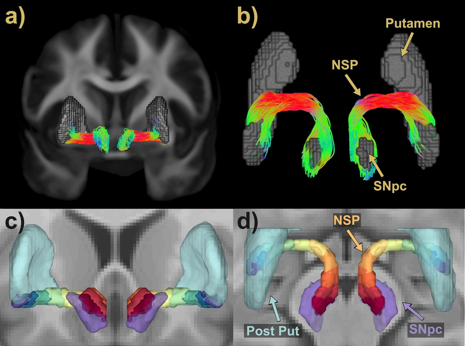 Tractography reconstruction of the nigrostriatal pathway showing putamen, NSP and SNpc