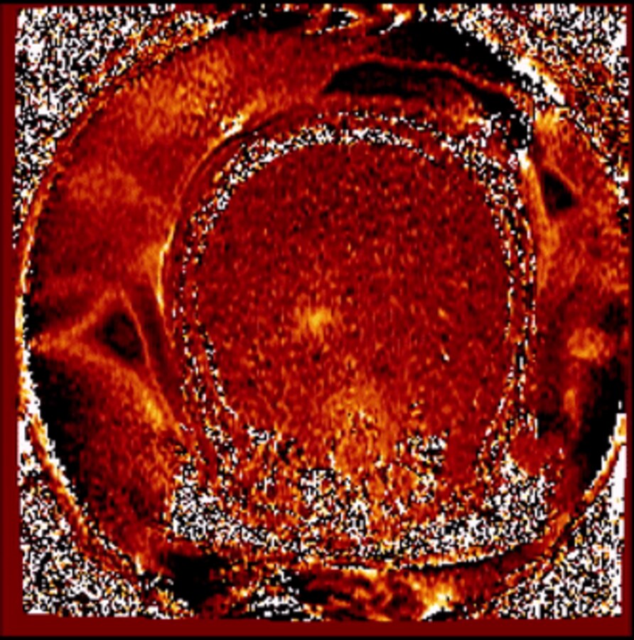 D3-HIFU — MR-guided high-intensity focused ultrasound